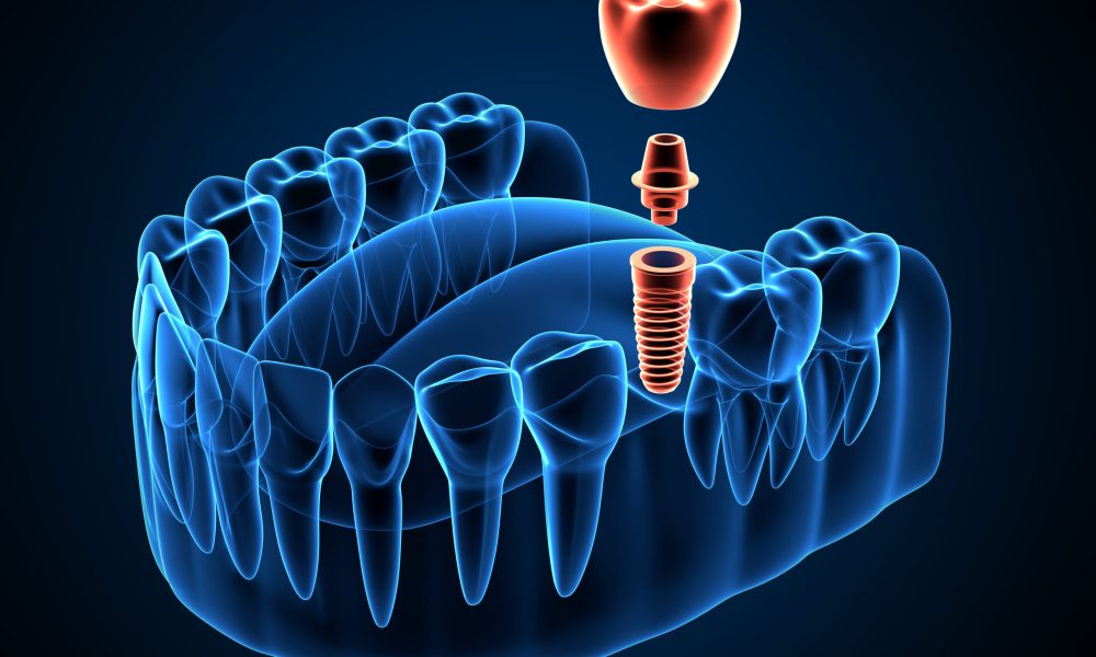 3d render of jaw x-ray  with dental implant placement